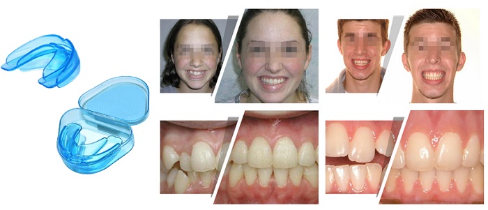 G-TOOTH TRAINER для выпрямления зубов: для самой обворожительной улыбки на свете!