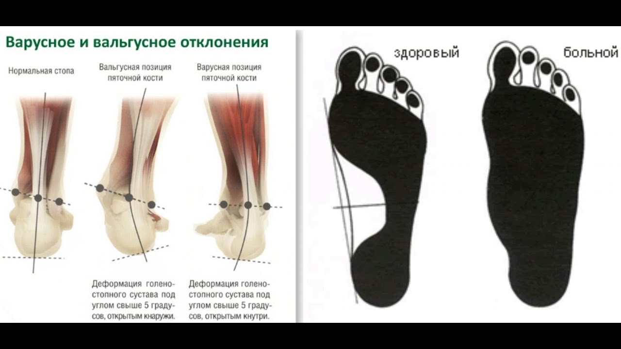 Вальгусная стопа и варусная стопа